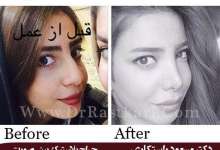 جراحی بینی