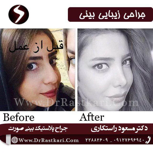 جراحی بینی