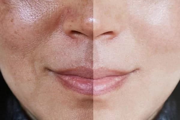 بهترین روش برای رفع تیرگی پوست صورت | علت تیره شدن پوست صورت در طب سنتی