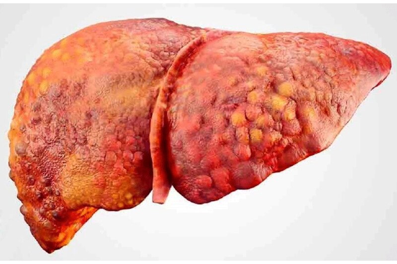 کارهایی که کبد انسان را از کار می‌اندازد