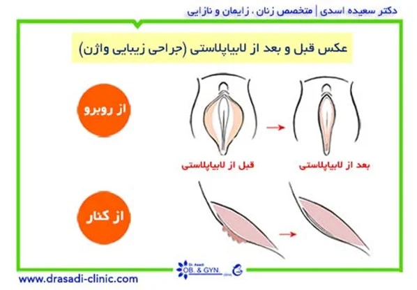 اپل | جراحی