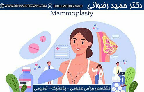 What is mammoplasty?
