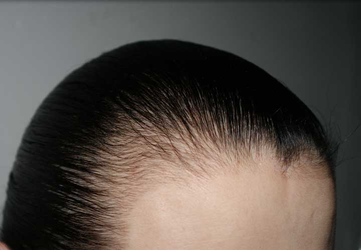 Hormonal hair loss and its treatment methods