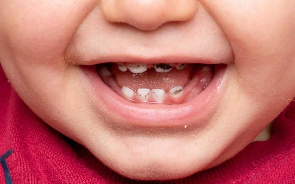 قطره آهن دندان را سیاه می‌کند