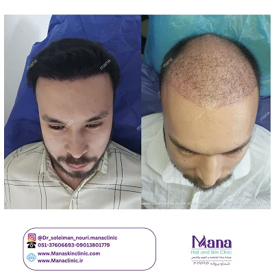 کاشت مو قبل و بعد کاشت مو