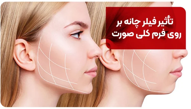تأثیر فیلر چانه بر روی فرم کلی صورت
