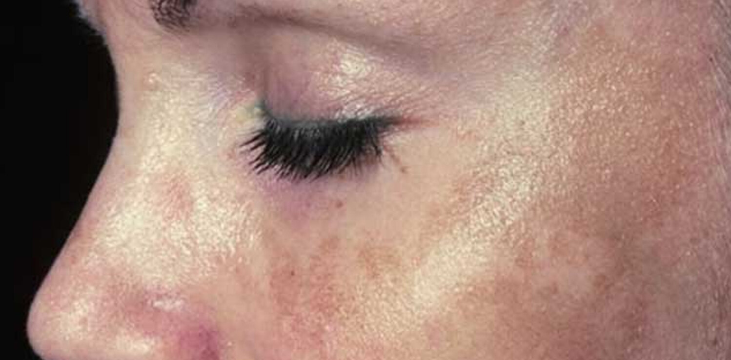 پوست بررسی علمی ترکیبات سرم ضد لک سیلکر